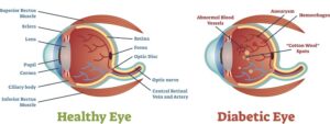 Graphic diagram of a diabetic eye vs a healthy eye