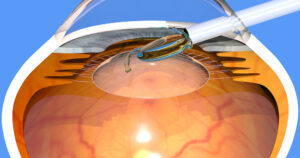 Diagram of implantable contact lens