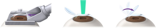 Graphic diagram of lasik eye surgery