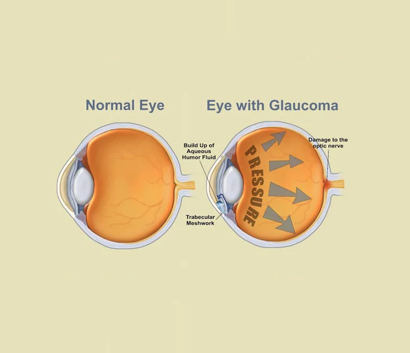 glaucoma eye diagram comparing regular eye